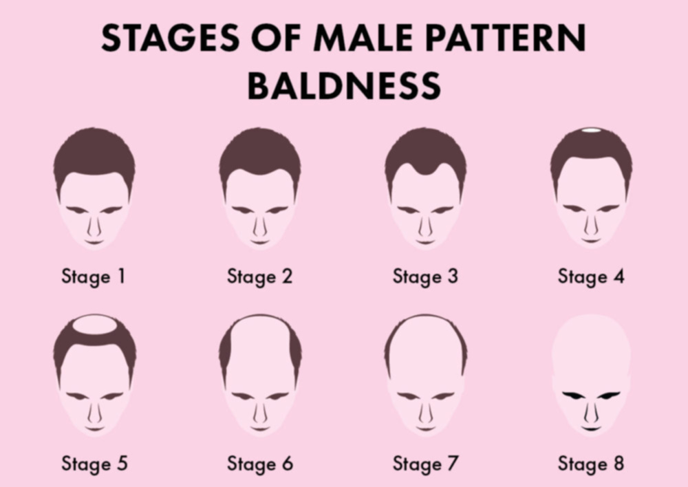 Male Pattern Baldness