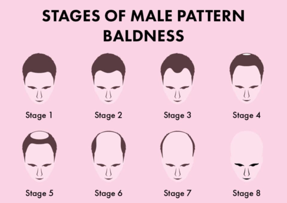 Male Pattern Baldness