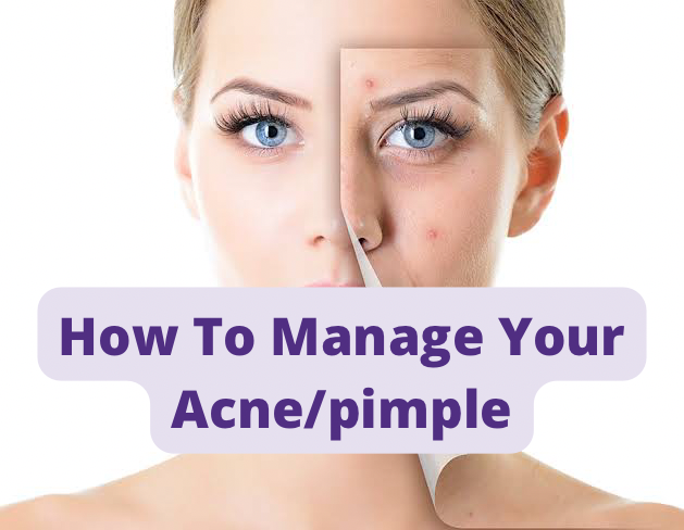 How To Manage Your Acne/Pimple