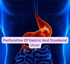 Deadly Ulcer: Perforation Of Gastric And Duodenal Ulcer