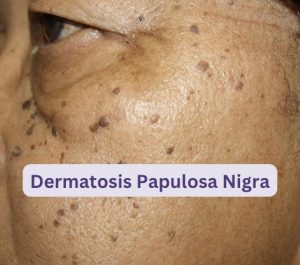 Dermatosis Papulosa Nigra- Causes And Treament