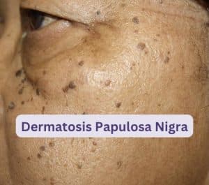 Dermatosis Papulosa Nigra- Causes And Treament