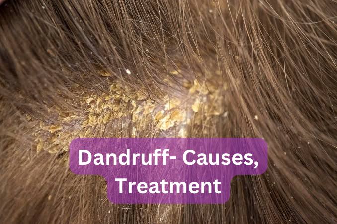 Reasons You Keep Having Dandruff