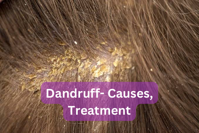 Reasons You Keep Having Dandruff