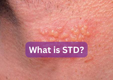 Understanding STD: What Is STD?