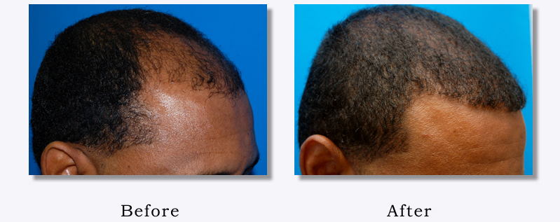 Hair Loss